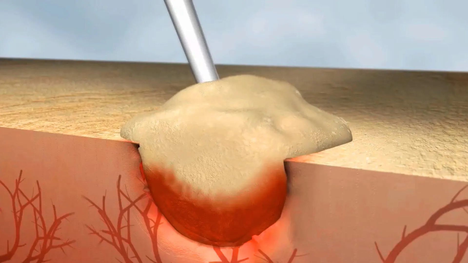 Illustration of Floseal sealant being applied to a wound