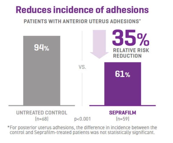 Seprafilm Adhesion Barrier Reduces the Incidence of Adhesions Following Myomectomy