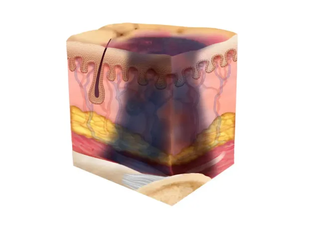 Illustration of a deep tissue pressure injury, with bruising from the surface of the skin to the bone