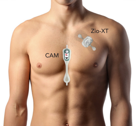 Image of a male torso showing the positioning of the CAM patch down the center of the sternumb versus the Zio-XT near the shoulder