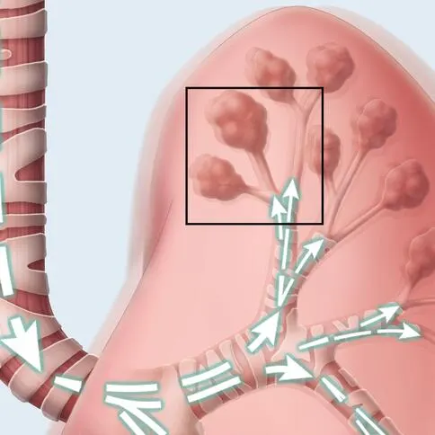 Lung mobilization CHFO image of secretions loosened