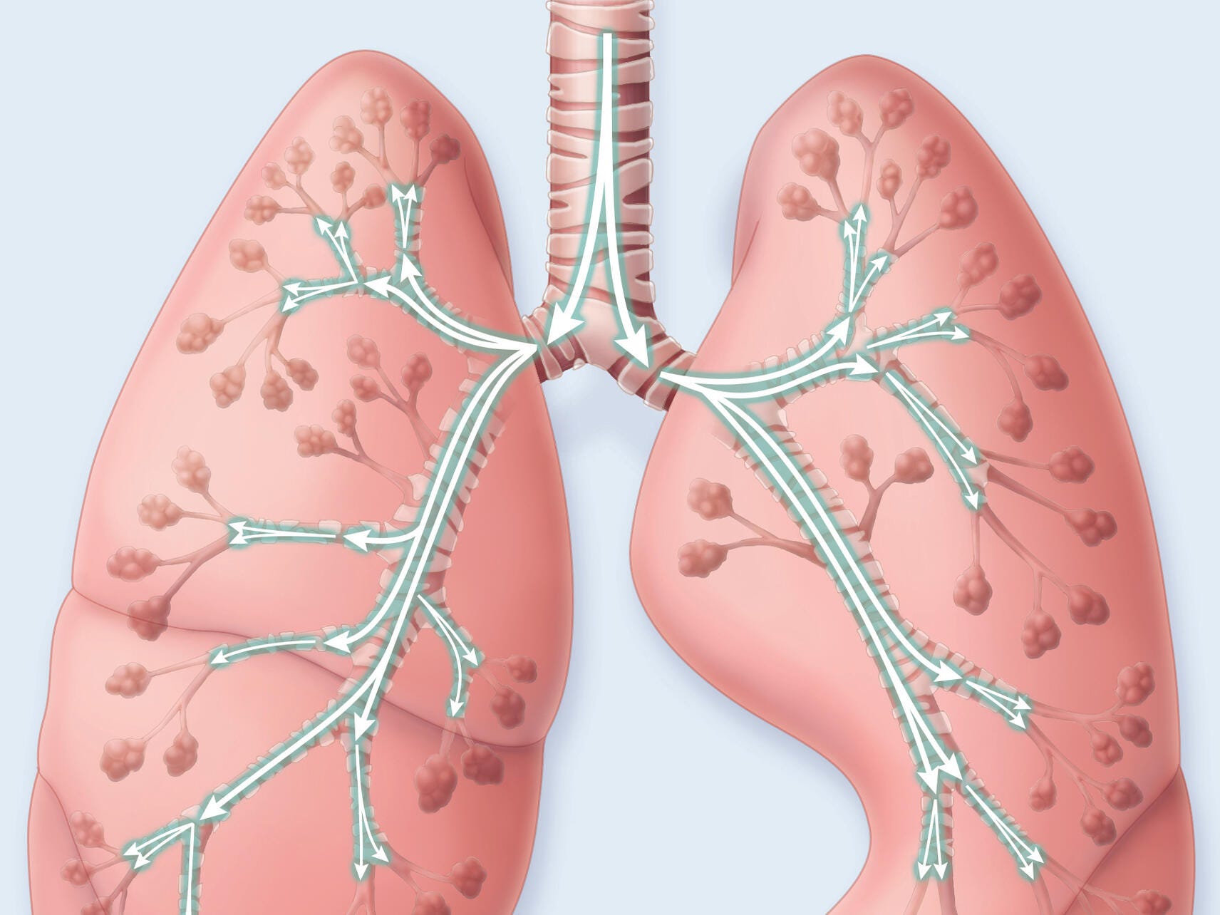 Illustration of lung expansion with the PODs designed to optimize airway clearance