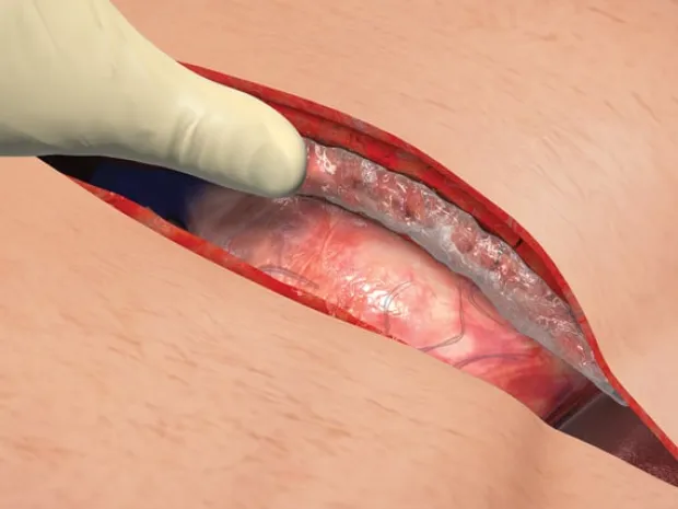 Ostene incision