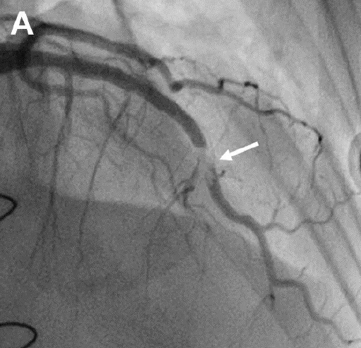 Mid-left anterior descending (LAD) artery filling defect representing a non-atherosclerotic blockage on coronary angiography