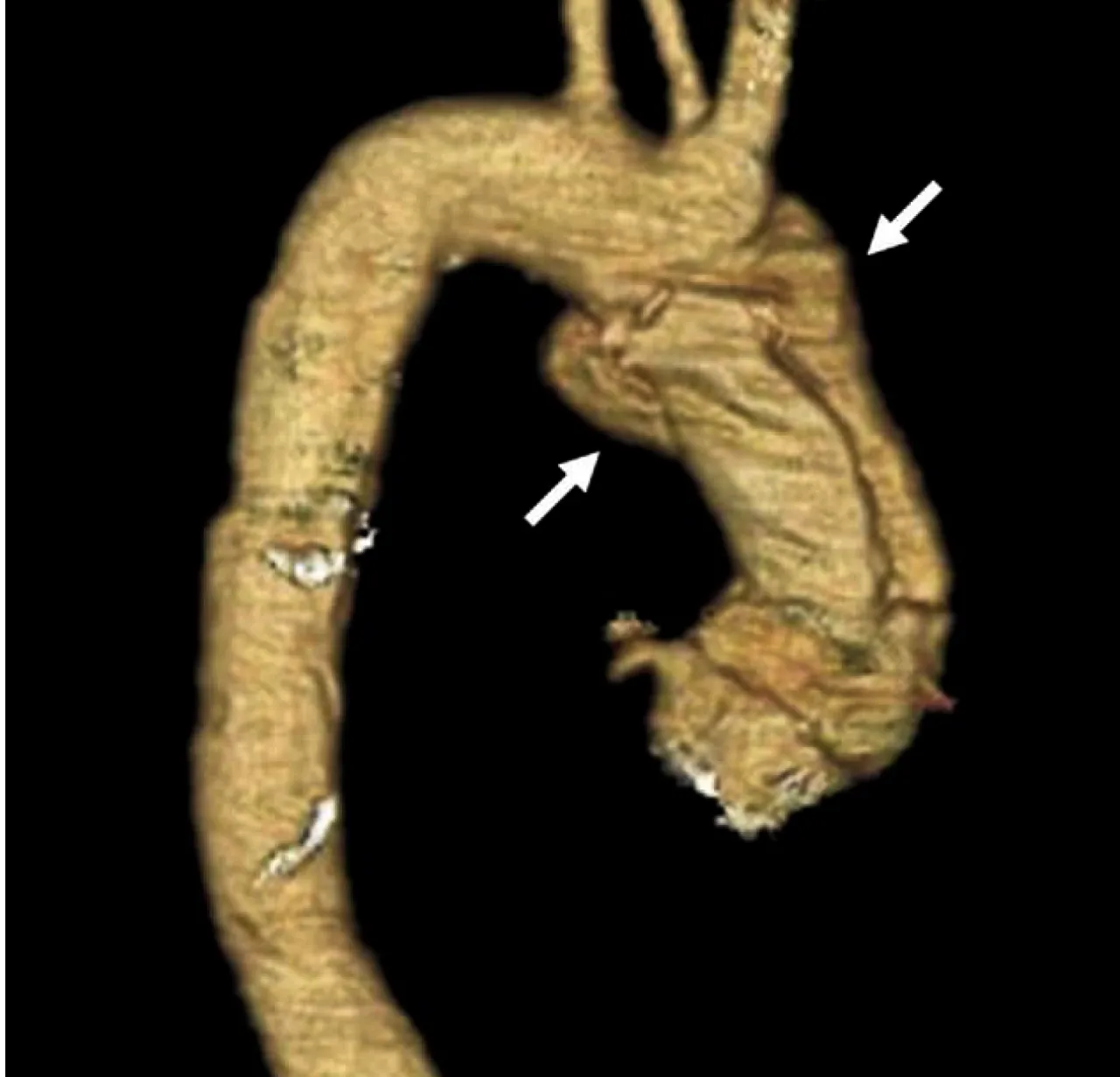 Aortic pseudoaneurysm formation