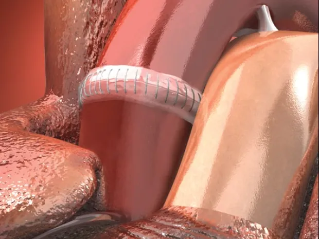 Coseal Aortic Application