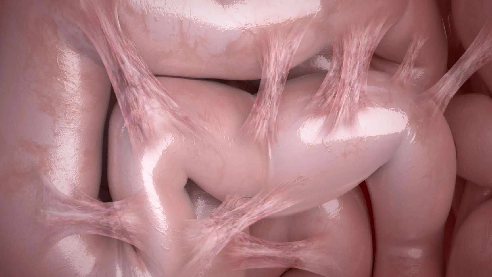 Render of adhesions on intestinal tubing