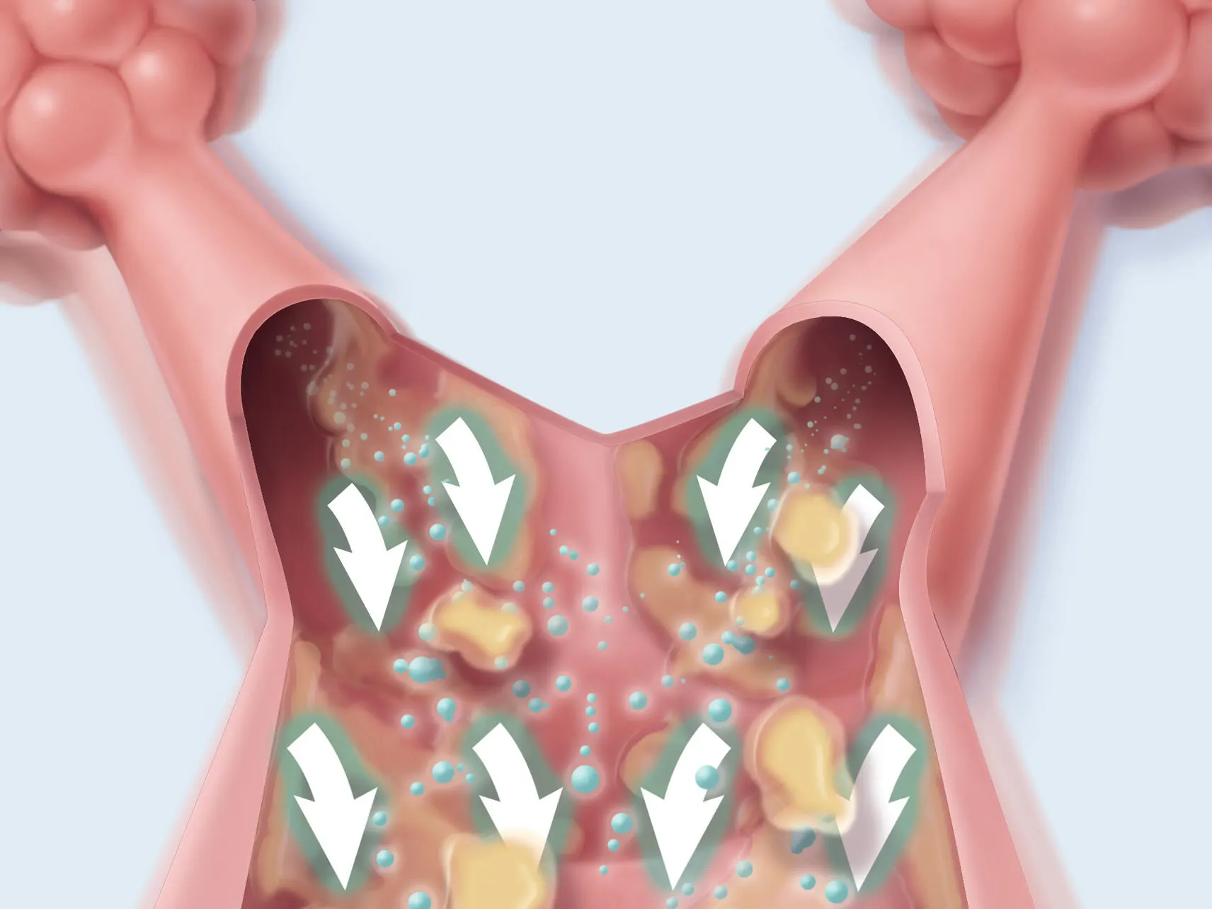 Airflow moves the mucus from small airways toward the large airways, from which they can be more easily expelled or removed.