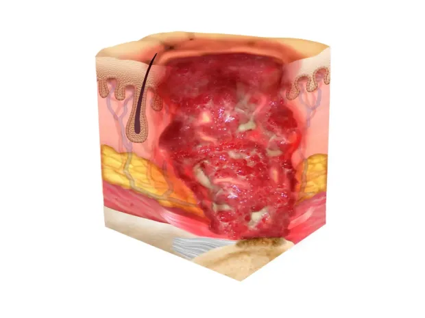 Illustration of a stage 4 pressure injury, where the wound is present down to the bone